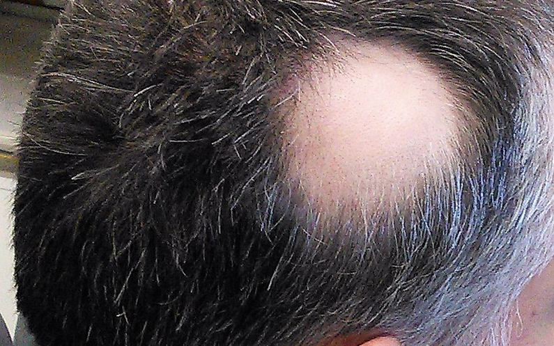 7 para saber es la alopecia areata - Rueber Centro Capilar