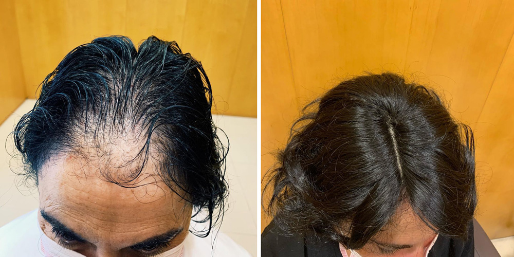 Alopecia Androgenética Femenina Causas Y Soluciones Rueber Centro