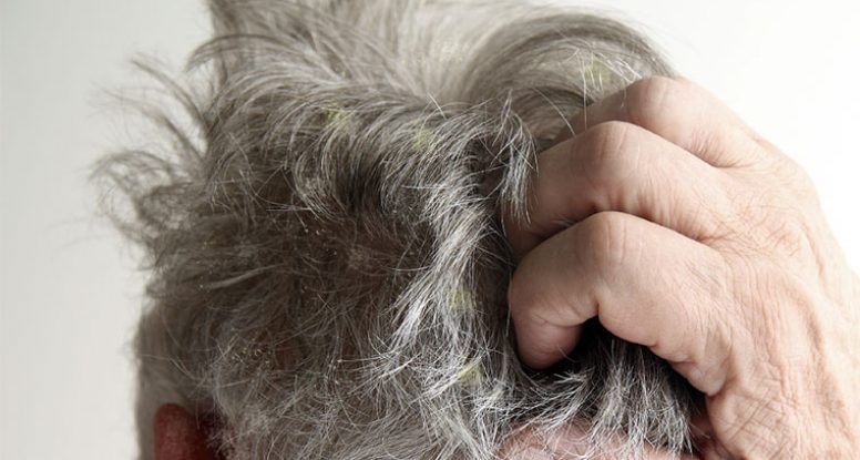 calina Árbol Visión general Dermatitis seborreica en el cuero cabelludo, causas y cuidado - Rueber  Centro Capilar