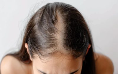 Alopecia difusa, comprender y tratar la pérdida de cabello generalizada